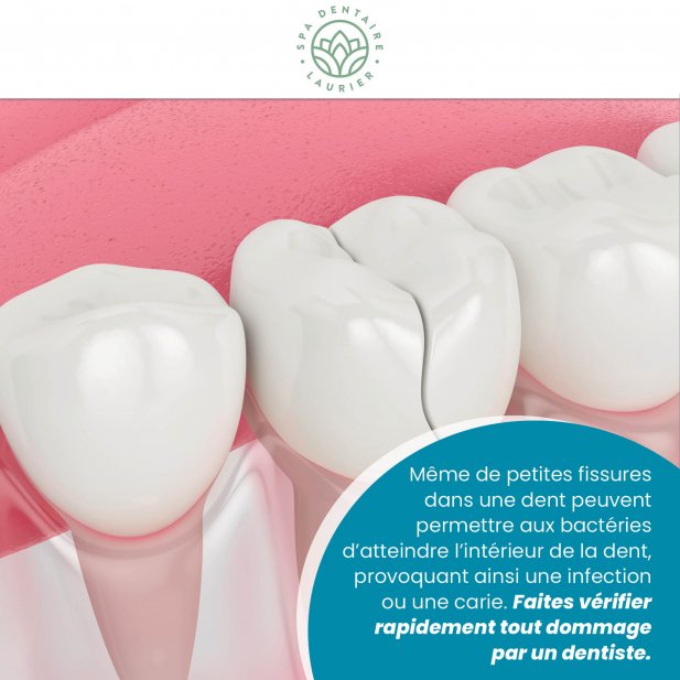 Everything you need to know before getting a dental crown Article - ArticleTed -  News and Articles