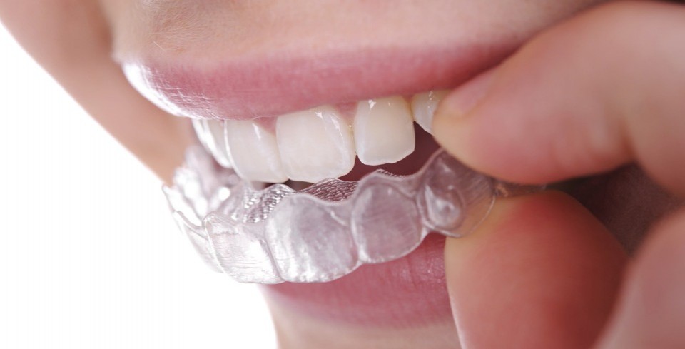 Invisible confidence: The quiet revolution in smiling correction | Image Dental Care