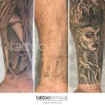 Tattoo Removal Australia Profile Picture
