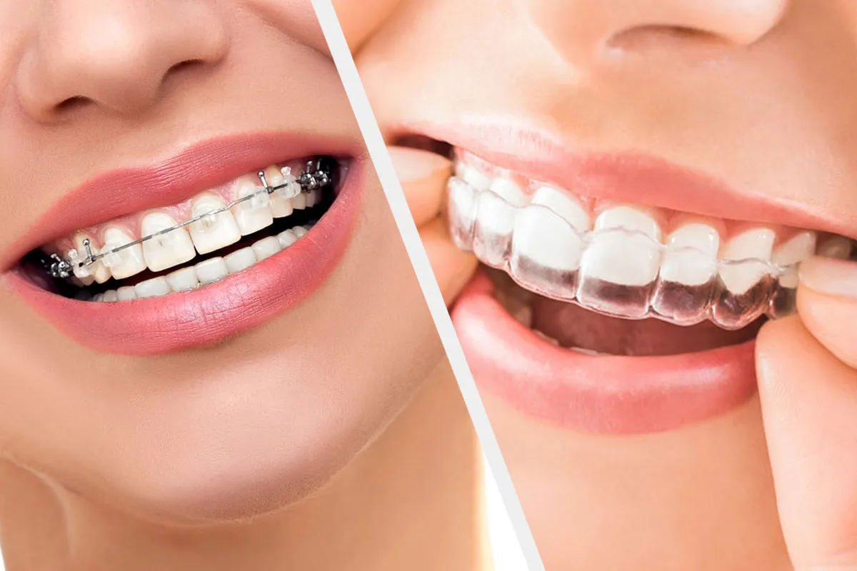 Invisalign Provider in RR Nagar – Site Title